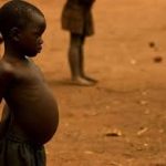 Picture of a child with Kwashiorkor